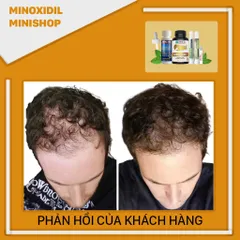 Combo Mọc Tóc Nâng Cao Minoxidil 5% + HairFluence + LCLT + Retinol + PEO Mix - Giải Pháp Tăng Tốc Mọc Tóc Hiệu Quả