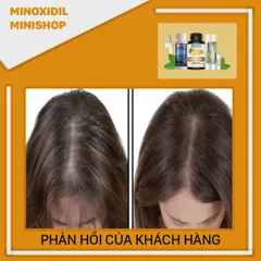 Combo Mọc Tóc Nâng Cao Minoxidil 5% + HairFluence + LCLT + Retinol + PEO Mix - Giải Pháp Tăng Tốc Mọc Tóc Hiệu Quả