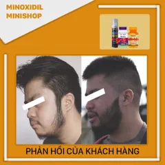 Dung Dịch Mọc Râu Tóc Kirkland 5% Minoxidil Dạng Bọt - Vitamin Biotin & Folic, Giúp Tóc Chắc Khỏe, Dinh Dưỡng Từ Mỹ