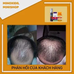 Dung Dịch Mọc Râu Tóc Kirkland 5% Minoxidil Dạng Bọt - Vitamin Biotin & Folic, Giúp Tóc Chắc Khỏe, Dinh Dưỡng Từ Mỹ
