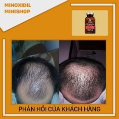 Advanced Trichology DHT Blocker Chống DHT - Mọc tóc - Giảm nhờn da đầu