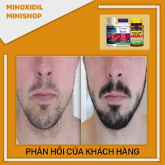 Combo Mọc Râu Tóc Minoxidil 5% + Biotin & Folic - Hỗ Trợ Tăng Trưởng Tóc Chắc Khỏe, Tặng Bột Hỗ Trợ LCLT