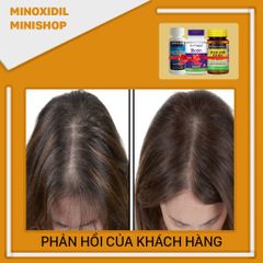 Combo Mọc Râu Tóc Minoxidil 5% + Biotin & Folic - Hỗ Trợ Tăng Trưởng Tóc Chắc Khỏe, Tặng Bột Hỗ Trợ LCLT