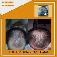 Dung Dịch Mọc Râu Tóc Minoxidil 5% Dạng Bọt - Giúp Mọc Râu Tơ Nhanh Chóng Sau 6-8 Tuần, Sản Phẩm Chính Hãng Từ Mỹ