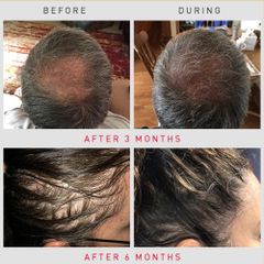 Xịt Mọc Tóc Minoxidil 5% Bailleul Pháp - Tinh Chất Mọc Tóc Hiệu Quả, Hỗ Trợ Liệu Trình Chăm Sóc Tóc, Dung Dịch Chất Lượng Cao