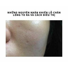 Peel da T.C.AGE Innoaesthetics - Exfo dành cho da lỗ chân lông to , da sẹo lõm 5ml/ lọ