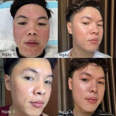 Huyết Tương Plasma Evenswiss Regenerating 10ml