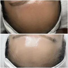 Max White Peel Mesotechl 5ml –  Dưỡng trắng da, làm sáng và tái tạo làn da căng mịn.