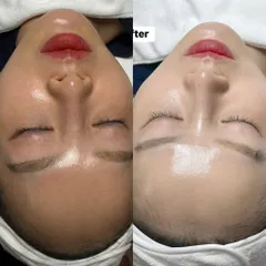Max White Peel Mesotechl 5ml –  Dưỡng trắng da, làm sáng và tái tạo làn da căng mịn.