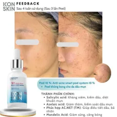 ICON SKIN Peel da 18% Anti-acne Smart Peel không bong 30ml