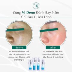 Vi Derm Beauty Retinoic Serum RX Tinh Chất Trẻ Hóa Da, Giảm Mụn 30ml Viderm