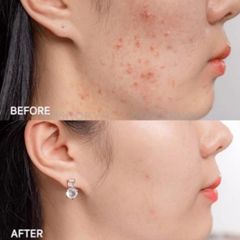 Acne Derm - AcneDerm 20% Azelaic Acid Giảm Thâm mụn, mờ nám, sáng da 20g
