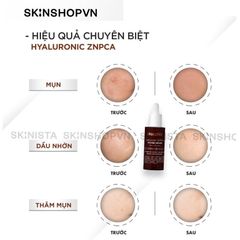Serum ZnPCA Ekseption Hyaluronic HA + 1% ZnPCA căng bóng, giảm mụn, kiềm dầu 75ml