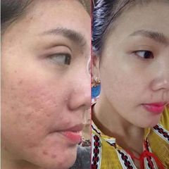 Gel Xóa Sẹo Strataderm Strapharma Thụy Sĩ - Giảm Sẹo Lồi, Sẹo Phì Đại, Chăm Sóc Da, Hiệu Quả Nhanh, An Toàn Cho Mọi Loại Sẹo