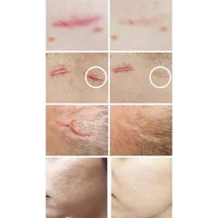 Kem Strataderm Xóa Mờ Sẹo Thâm, Sẹo Rỗ & Sẹo Lõm – Gel Chăm Sóc Da Nhập Khẩu Thụy Sĩ, Giảm Ngứa, Cải Thiện Sẹo Trên Mọi Bề Mặt Da