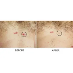 Gel Xóa Sẹo Strataderm 10g - Điều Trị Sẹo Lồi, Sẹo Rỗ, Sẹo Thâm Nhập Khẩu Thụy Sĩ - Giải Pháp Tốt Nhất Cho Làn Da Bạn