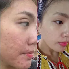 Gel Xóa Sẹo Strataderm 10g - Điều Trị Sẹo Lồi, Sẹo Rỗ, Sẹo Thâm Nhập Khẩu Thụy Sĩ - Giải Pháp Tốt Nhất Cho Làn Da Bạn