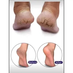 Kem Dưỡng Gót Chân Scholl Schrunden Salbe 25% Urea – Hỗ Trợ Chăm Sóc Da Chân Khô