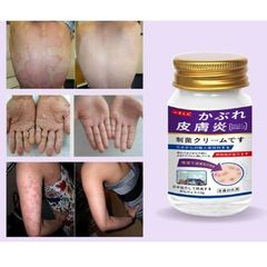 Kem Bôi Da Liễu Nakusa Nhật Bản 55G - Giảm Ngứa, Chống Viêm Da, Hắc Lào, Vẩy Nến, Dành Cho Da Nhạy Cảm