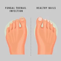[Hàng nội địa Mỹ] Serum bôi nấm móng tay, chân dạng bút Neomen của Mỹ