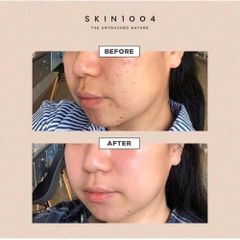 Tinh Chất Serum Rau Má Skin1004 Madagascar Centella 100ml - Giải Quyết Mụn và Da Nhạy Cảm, Làm Dịu và Phục Hồi Da Tổn Thương