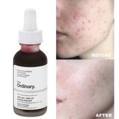 Tinh Chất Serum Tẩy Tế Bào Chết The Ordinary AHA 30% + BHA 2% 30ml - Giải Pháp Làm Sáng Da, Cải Thiện Mụn, Se Khít Lỗ Chân Lông