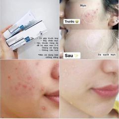 Kem Làm Giảm Mụn Galderma Differ 0.1% 30g – Hỗ Trợ Làm Giảm Mụn Trứng Cá 387757