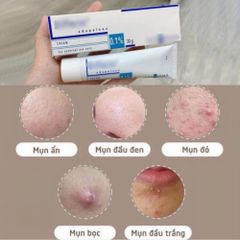 Kem Làm Giảm Mụn Galderma Differ 0.1% 30g – Hỗ Trợ Làm Giảm Mụn Trứng Cá 387757