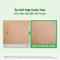 Tinh Chất Serum Giảm Mẩn Đỏ Torriden Balanceful Cica 50ml - Dưỡng Ẩm, Phục Hồi Da Nhạy Cảm