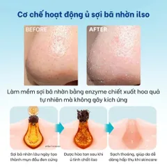 Tinh Chất Ủ Mụn Đầu Đen Softener + Bông Cotton 1/3 Tiết Kiệm – Làm Sạch Mụn, Dưỡng Da Dịu Nhẹ 387789