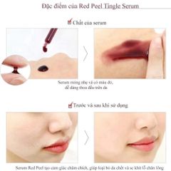 Tinh Chất Serum Red Peel Tingle So Natural 35ml - Tẩy Tế Bào Chết Hóa Học, Làm Sáng & Mịn Da, Giúp Thu Nhỏ Lỗ Chân Lông