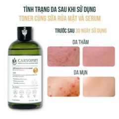 Nước Hoa Hồng Caryophy Portulaca Toner 300ml - Giảm Mụn, Làm Dịu Da, Cân Bằng pH - Dưỡng Da Từ Thiên Nhiên Hàn Quốc