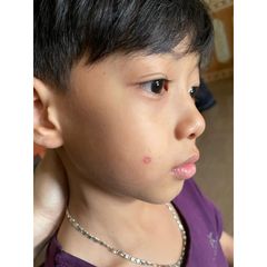 Kem Tẩy Nốt Ruồi Tàn Nhang Hiệu Quả Tại Nhà - Xoá Mụn Thịt, Mụn Cóc 8g - An Toàn, Dễ Dùng