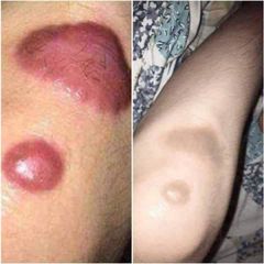 Combo 2 Cao Xoá Sẹo Collagen Giúp Làm Mờ Sẹo Lồi, Lõm và Hỗ Trợ Làm Lành Vết Thương Nhanh Chóng, Căng Bóng Da