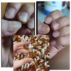 Combo 5 Chai Serum Phục Hồi Móng - Chữa Nấm Móng và Hư Khóe, Giải Quyết Bọng Móng, Dễ Dàng Sử Dụng 4ml