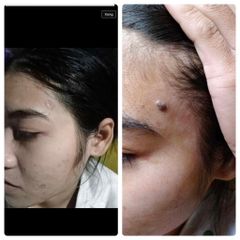 Gel Tẩy Nốt Ruồi Dvelinil - Xóa Mụn Cóc, Mụn Thịt & Sẹo Lồi An Toàn Tại Nhà - Cam Kết Chính Hãng, Hiệu Quả Ngay Lần Đầu Sử Dụng