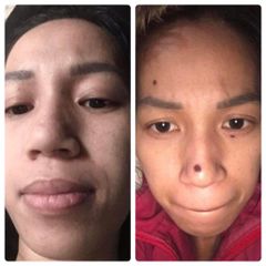Gel Tẩy Nốt Ruồi Dvelinil - Xóa Mụn Cóc, Mụn Thịt & Sẹo Lồi An Toàn Tại Nhà - Cam Kết Chính Hãng, Hiệu Quả Ngay Lần Đầu Sử Dụng