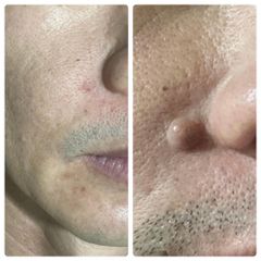 Gel Tẩy Nốt Ruồi Dvelinil - Xóa Mụn Cóc, Mụn Thịt & Sẹo Lồi An Toàn Tại Nhà - Cam Kết Chính Hãng, Hiệu Quả Ngay Lần Đầu Sử Dụng
