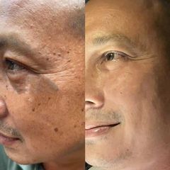 Gel Tẩy Nốt Ruồi Collagen Tại Nhà - Xóa Mụn Cơm, Đồi Mồi, Sẹo Lồi - Da Mịn Màng, Sạch Sẽ, Không Để Lại Sẹo
