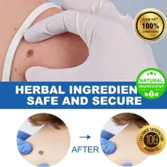 Bút Chấm Mụn Cóc và Nốt Ruồi EELHOE - Giải Pháp Tự Nhiên Loại Bỏ Mụn Thịt Thừa, Hiệu Quả Rõ Rệt Sau 2 Tuần Sử Dụng