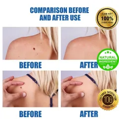 Bút Chấm Mụn Cóc và Nốt Ruồi EELHOE - Giải Pháp Tự Nhiên Loại Bỏ Mụn Thịt Thừa, Hiệu Quả Rõ Rệt Sau 2 Tuần Sử Dụng