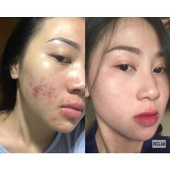 Serum Mụn Detox - Làm Sạch Mụn Ẩn, Mụn Đầu Đen, Mờ Thâm Nám, Sáng Da, Kháng Khuẩn, Cấp Ẩm Tốt