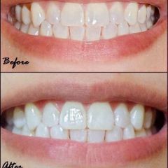 Kem đánh răng Crest 3D White Advanced Triple Whitening 158g - Làm trắng và bảo vệ răng miệng hiệu quả từ Mỹ