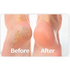 Kem Bôi Da Chống Nẻ Gót Chân Thẩm Thấu Nhanh - Dưỡng Ẩm Da Mềm Mịn Thiên Di, Hủ 8gr, Phù Hợp Mọi Loại Da