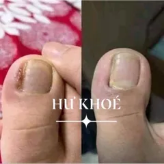 Combo 10 Lọ Serum Dưỡng Móng Chân Tay, Chữa Hư Khoé và Bọng Móng, Nước Ăn Móng Gia Truyền 4ml - Hiệu Quả Nhanh Chóng