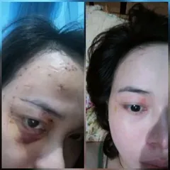 Cao Xoá Sẹo Collagen 10gr - Mờ Sẹo Lồi Lõm, Hỗ Trợ Lành Vết Thương, Trẻ Hóa Da, Ngăn Ngừa Lão Hóa, Da Trắng Hồng Căng Bóng