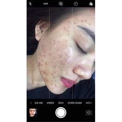 Serum Giảm Mụn Thâm Rỗ Skin 7 Days - 5 Trong 1 Hiệu Quả Sau 7 Ngày - Dưỡng Da Tự Nhiên An Toàn 10ml