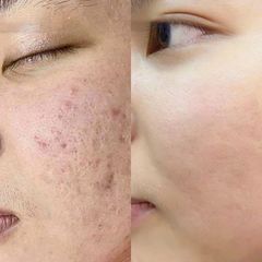 Combo 2 Lọ Cao Xoá Sẹo Collagen Mờ Sẹo Lồi Lõm - Giúp Nhanh Lành Vết Thương, Không Để Lại Sẹo cho Mẹ Bầu và Mẹ Bỉm