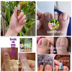 Combo 10 Serum Chống Nấm Móng & Hư Khoé - Giảm Đau & Hiệu Quả Nhanh 4ml, Phù Hợp Cho Nail Salon