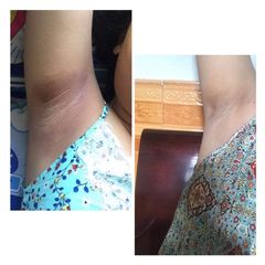 Combo 5 Lọ Kem Khử Thâm Nách & Hôi Nách Cô Bơ - Dưỡng Da Mịn Màng, Giảm Thâm Nách Hiệu Quả, An Toàn Cho Phụ Nữ & Trẻ Em